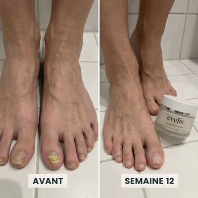 Éliminez la mycose des ongles naturellement et durablement