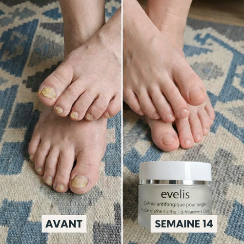Éliminez la mycose des ongles naturellement et durablement