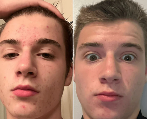 Extracteur de Points Noirs Porify Mee-Eter