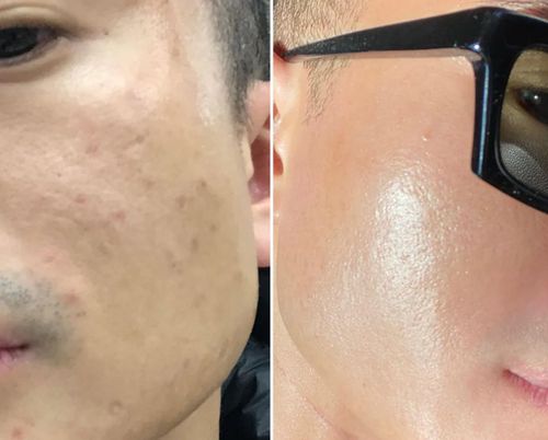 Extracteur de Points Noirs Porify Mee-Eter