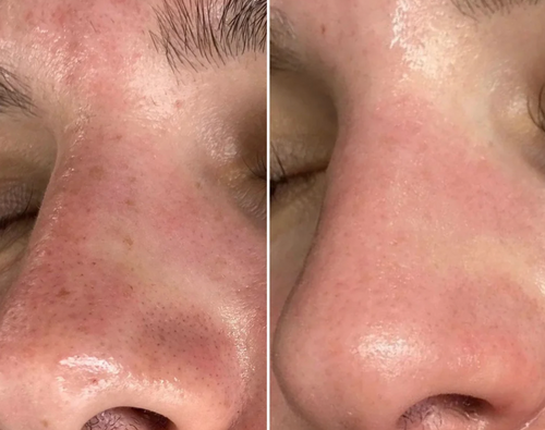 Extracteur de Points Noirs Porify Mee-Eter