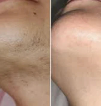 Spécialement formulée pour les poils liés au SOPK, pour une peau naturellement lisse