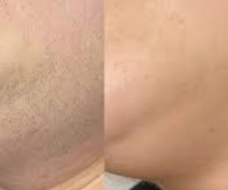 Spécialement formulée pour les poils liés au SOPK, pour une peau naturellement lisse