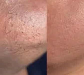 Spécialement formulée pour les poils liés au SOPK, pour une peau naturellement lisse