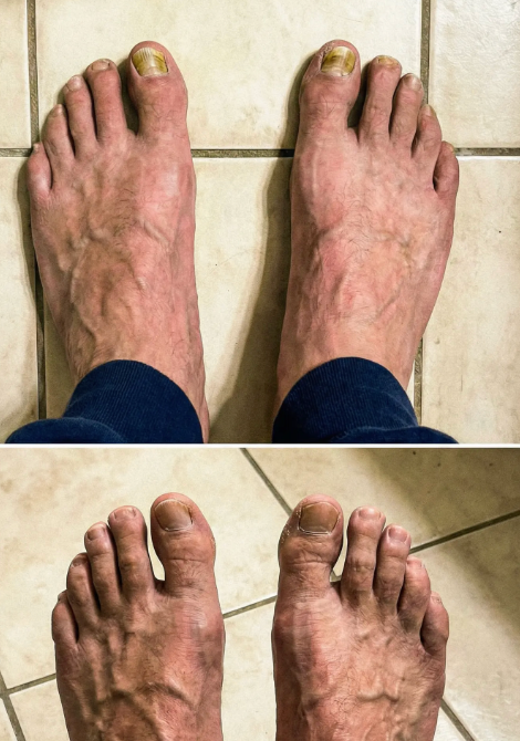 Éliminez la mycose des ongles naturellement et durablement