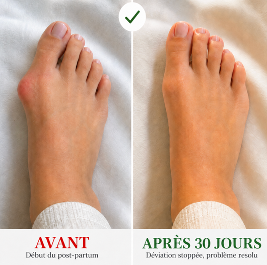 Velora Aligne™ | Le dispositif qui stoppe les oignons sans chirurgie